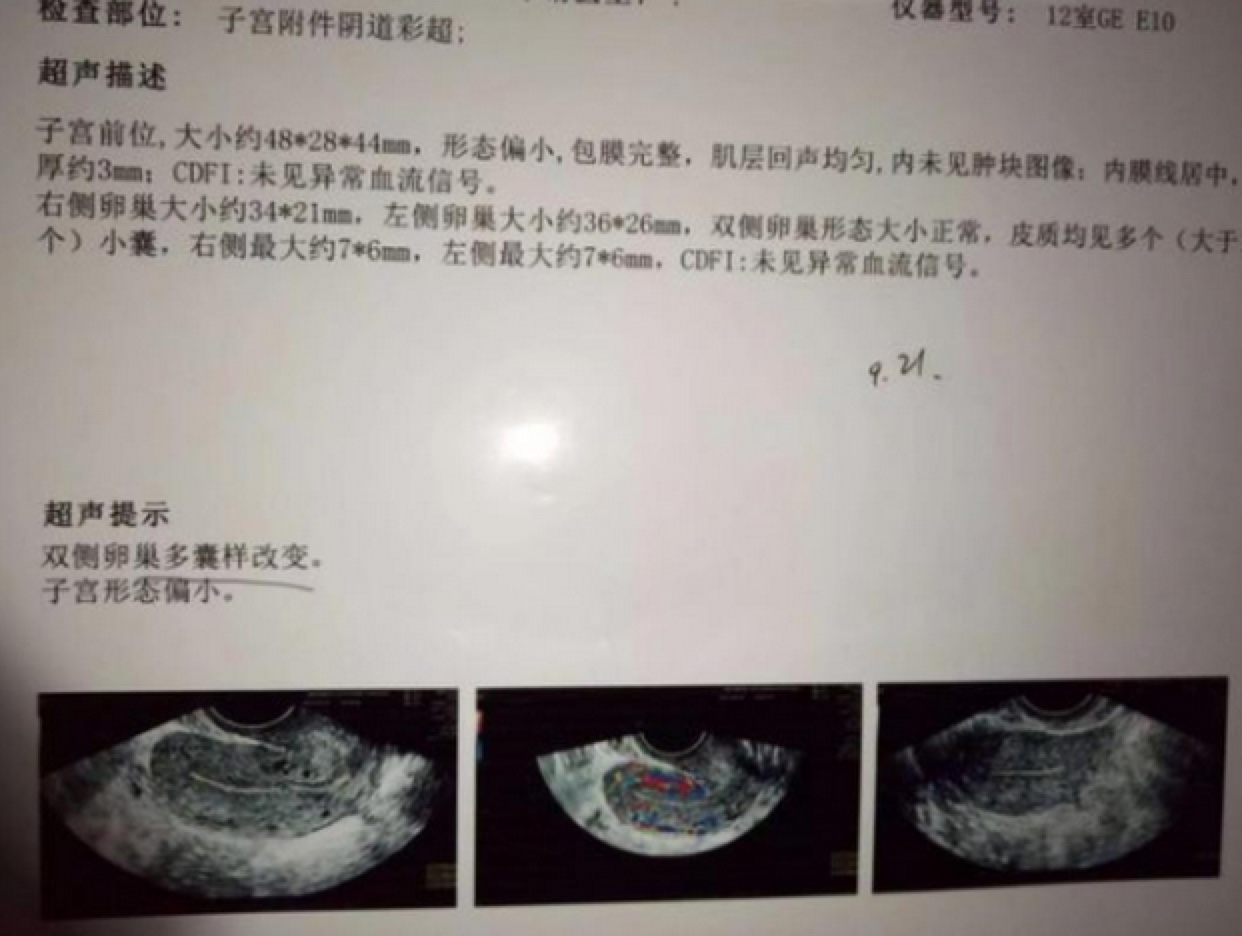 给大家说说我多囊是怎么备孕升级的