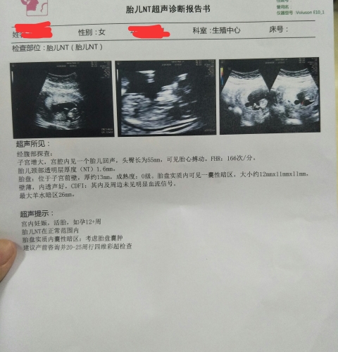 孕12周，NT顺利通过了！
